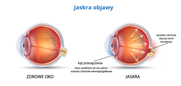 jaskra - oczy - jak wygląda choroba