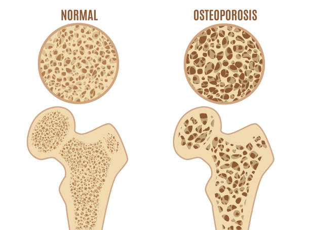 kość zdrowa i z osteoporozą grafika